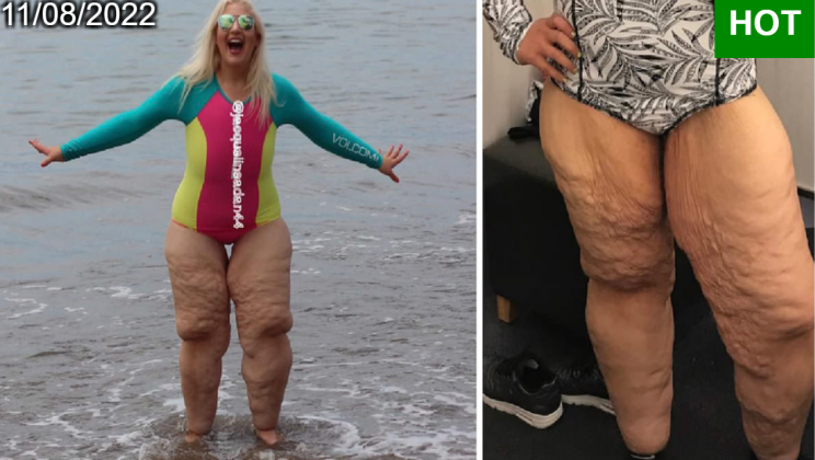 Bullies laughed at her ‘ugly’ legs – but what she did in response silenced them all