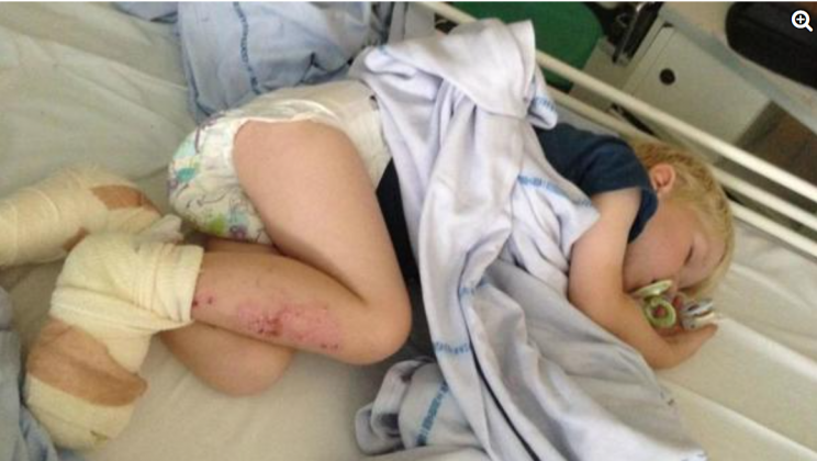 A 3-year-old kid almost lost his toes at the beach – now his mother warns of the danger hidden in the sand