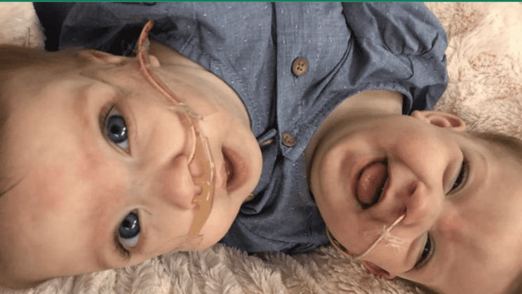 An 11-Hour Surgery Successfully Separates Conjoined Twins “Locked In An Embrace”