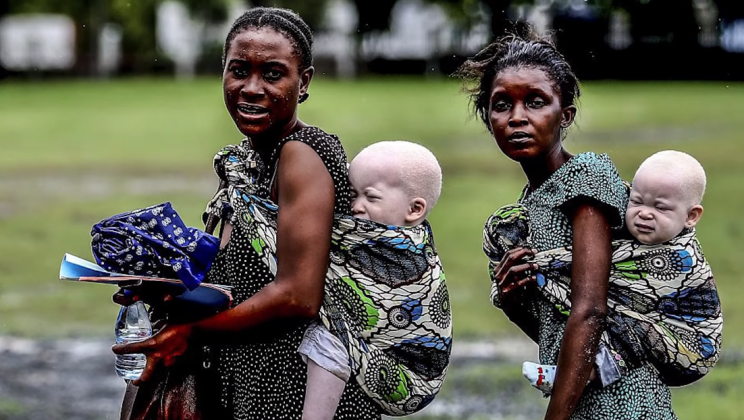 She gave birth to albino twins with snow-white hair. See how they look now…