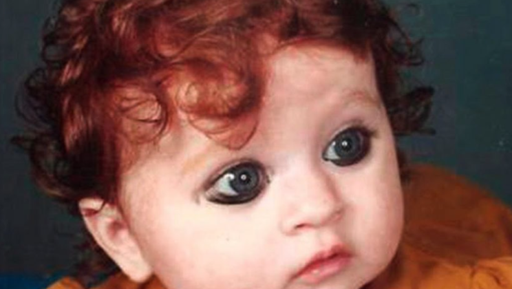 This baby was ridiculed as a child for her unusual appearance. She grew up and was able to accept herself