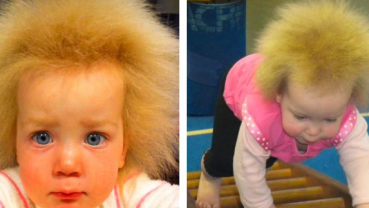 What does a dandelion girl with “uncombed hair syndrome” look like now? She is already 10 years old