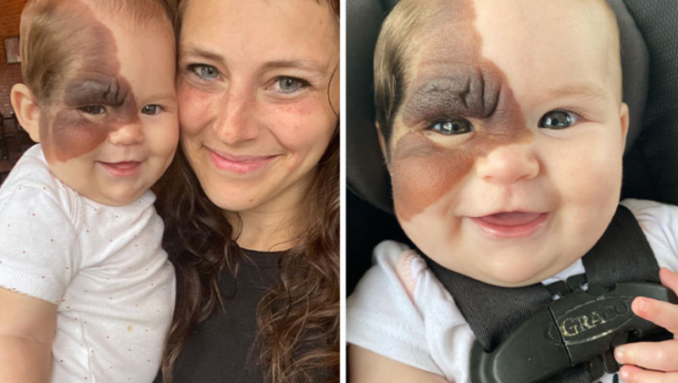 This baby was born with this mark on his face, his parents decided to abandon him, this story will make you cry